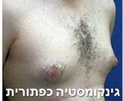 ניתוח גינקומסטיה