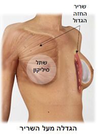 הגדלה מעל השריר