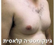ניתוח גינקומסטיה