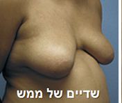 ניתוח חזה