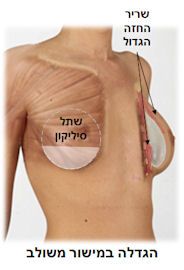הגדלת חזה במישור משולב