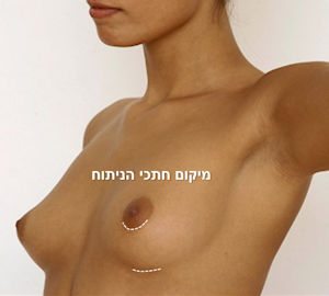 ניתוח הגדלת חזה
