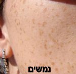 הסרת גידולי עור