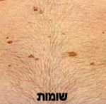 הסרת גידולי עור