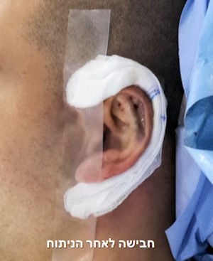 חבישת האוזן לאחר ניתוח הצמדת אוזניים