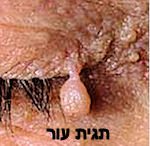 הסרת גידולי עור