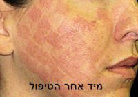 טיפול פנים מייד אחרי