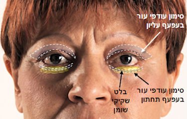 עודפי עור בעפעף תחתון