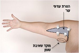 הסרת עודפי עור