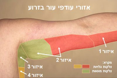 עודפי עור בזרוע