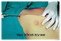 ניתוח גינקומסטיה