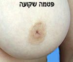 פטמה שקועה