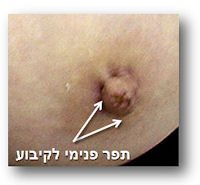 ניתוח חזה תפר פנימי פטמה לקיבוע