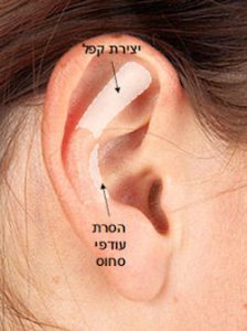 ניתוח הצמדת אוזניים