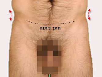 ניתוחי גוף גברים