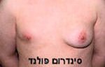 סינדרום פולנד