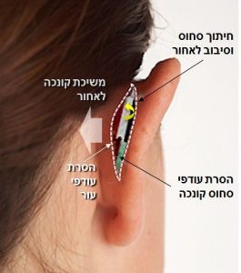 ניתוח הצמדת אוזניים