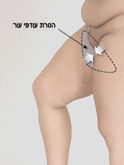 הסרת עודפי עור