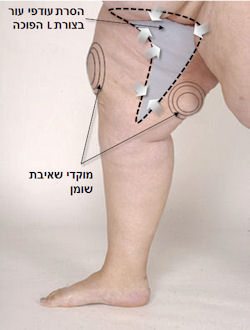 הסרת עודפי עור