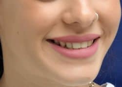 גומות חן