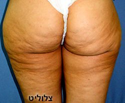 cellulite