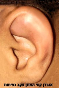 earswelling1