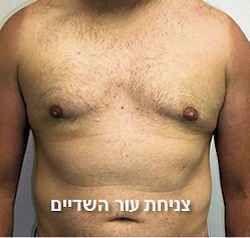 gynecomastiabreastsptosis