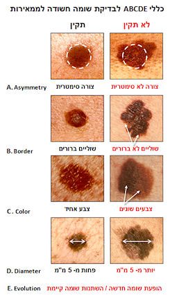 הסרת שומות