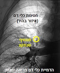 pulmonaryem