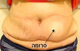 seroma