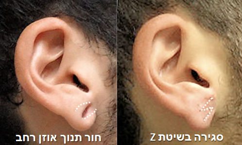 תיקון תנוך אוזן