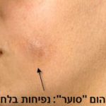 נפיחות בלחי