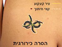 הסרת קעקוע-הסרה כירורגית