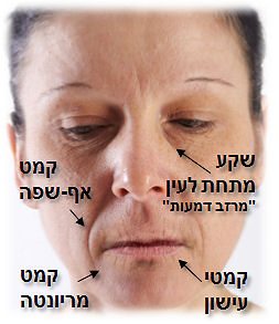 מילוי קמטים