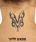 הסרת קעקועים