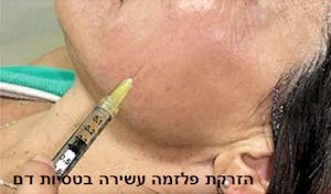 הזרקת פלזמה עשירה בטסיות הדם