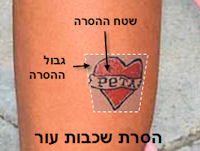 הסרת שכבות עור