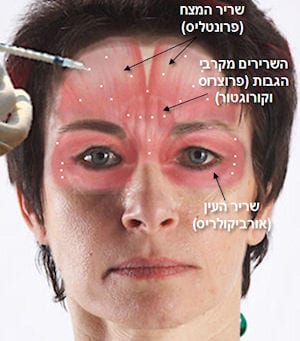 הזרקת בוטוקס ®