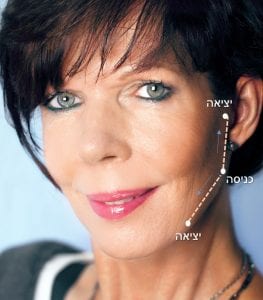 מתיחת פנים ללא ניתוח