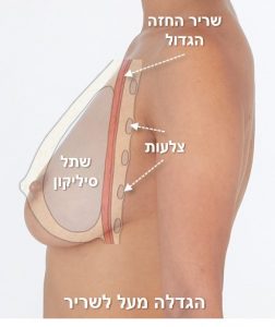 הגדלת שדיים מעל לשריר החזה הגדול