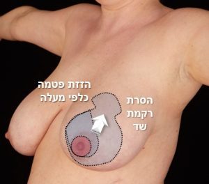 סימון חתכי ניתוח הקטנת חזה