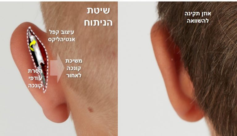אוזניים בולטות - טכניקת ניתוח