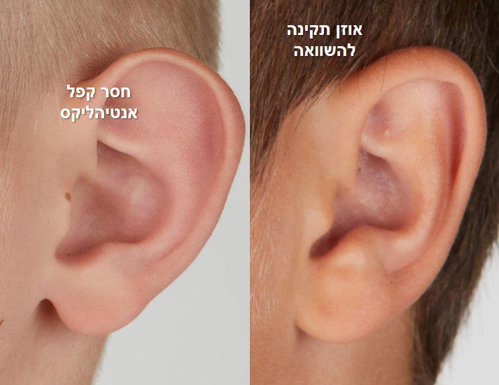 אוזניים בולטות - מבט מהצד