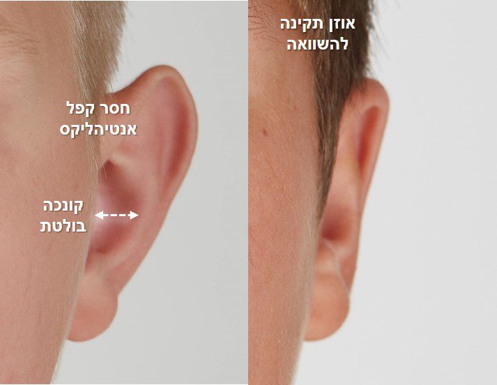אוזניים בולטות - מבט מלפנים