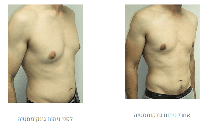 גניקומסטיה לפני ואחרי