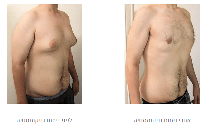 גניקומסטיה לפני ואחרי
