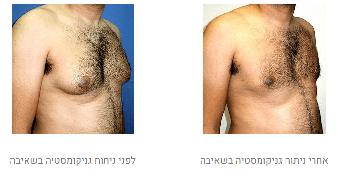 גניקומסטיה לפני ואחרי
