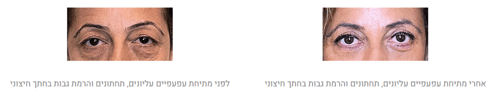 הרמת גבות לפני ואחרי