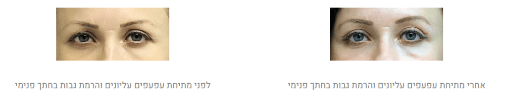 הרמת גבות לפני ואחרי