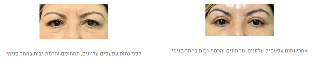 הרמת גבות לפני ואחרי